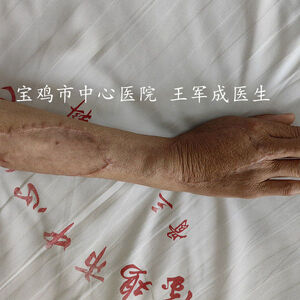 前几天完成一例左手拇指旋转撕脱离断伤 ...